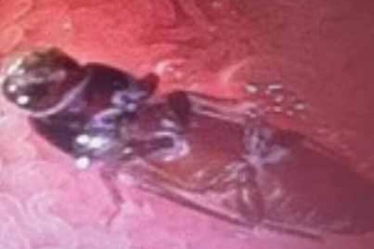 युवक के पेट हुआ, निकला जिंदा कॉकरोच, एंडोस्कोपी रिपोर्ट में हुआ खुलासा